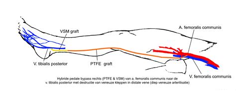 bypass links.